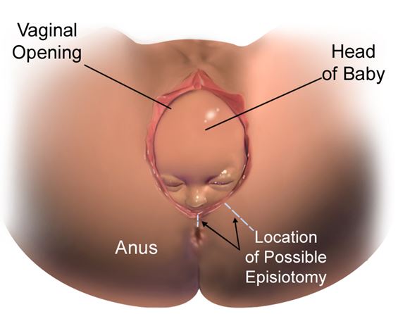 Graphic of normal vaginal delivery - preferred birthing option 