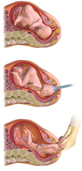 Graphic showing a vacuum assisted vaginal delivery birthing option method